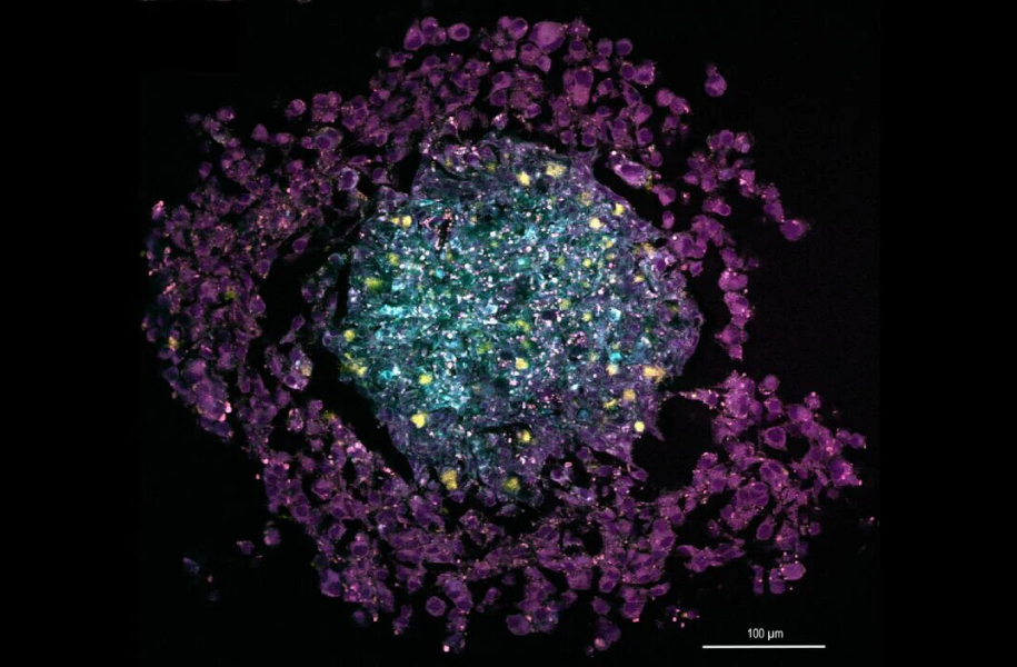 Многоцветное SRS-изображение трехклеточного сфероида рака, на котором показаны общие липиды (желтый, 2850 см-1), ненасыщенные липиды (пурпурный, 3050 см-1) и коллаген (SHG, голубой). Масштаб шкалы составляет 100 мкм. Пример предоставлен Рюдигером Рудольфом, Юлией Кликс, Высшей школой Мангейма, Германия.