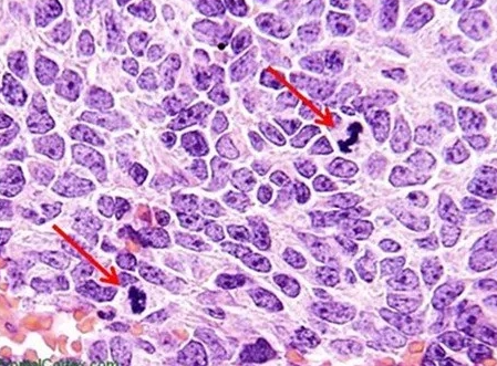 Рис .2: На этом изображении крупноклеточной анапластической медуллобластомы гематоксилин играет ключевую роль в диагностике. Обратите внимание на митотические фигуры, указывающие на быстро растущую опухоль. В клетках также отмечается ядерная нерегулярность и скопление хроматина.