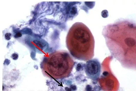 Рис.4: На этом изображении мазка Папаниколау пациента с плоскоклеточным раком можно оценить разнообразие окраски цитоплазмы. Красная стрелка указывает на злокачественное ядро ​​с очень малым количеством цитоплазмы. Черная стрелка иллюстрирует нормализованную клетку острого воспаления, сходную по размеру эритроцитов на предыдущем изображении. Обратите внимание, насколько больше злокачественная клетка по сравнению с нормальными ядрами на предыдущем изображении.