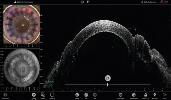 Программное обеспечение InVivo системы интраоперационной оптической когерентной томографии (ОКТ) EnFocus, показывающее структуру роговицы в квадропроекции. Смотрите на изображение из окуляра микроскопа в верхнем левом углу и вид EnFace в нижнем левом, а также изображение B-скана оптической когерентной томографии (ОКТ) справа.