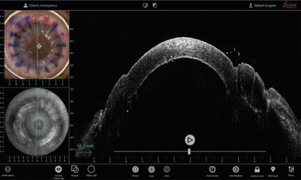 Програмне забезпечення InVivo системи інтраопераційної оптичної когерентної томографії (ОКТ) EnFocus, що показує структуру рогівки в квадропроекції. Дивіться на зображення з окуляру мікроскопу у верхньому лівому куту та вигляд EnFace в нижньому лівому, а також зображення B-скану оптичної когерентної томографії (ОКТ) праворуч.