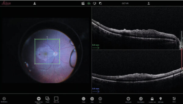 Поле зрения микроскопа при работе на заднем отрезке (слева) с дополнением EnFocus OCT (справа) для визуализации отслоения мембраны. Изображение предоставлено доктором Массимо Д’Атри, Кальяри, Италия.